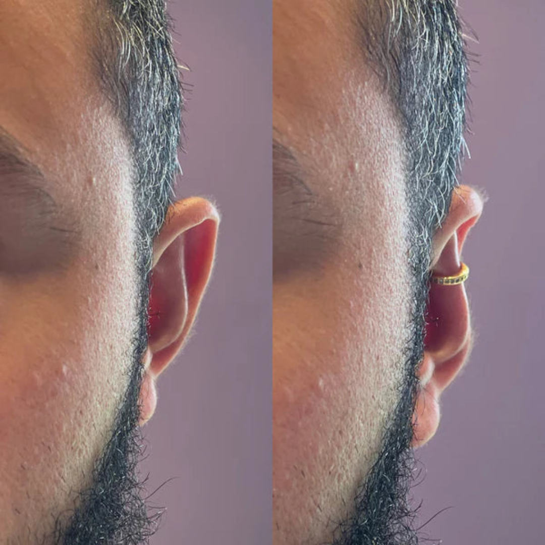 Lumivue™- Earfix